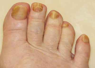 foot nail fungus